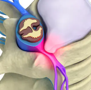 Douleurs neurologiques, sciatique